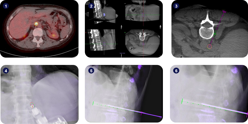Robot-guided para-aortic biopsy using Micromate