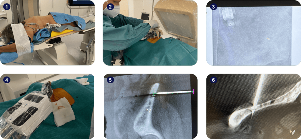 Robot assisted bone biopsy compilation of images