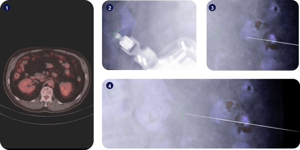 Omental Biopsy Images