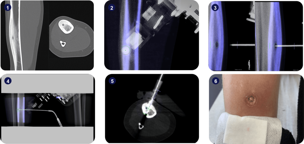 Osteoid Osteoma Cryoablation case report images