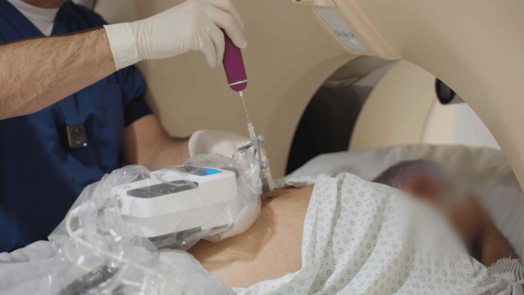 Micromate used in a CT-guided percutaneous biopsy