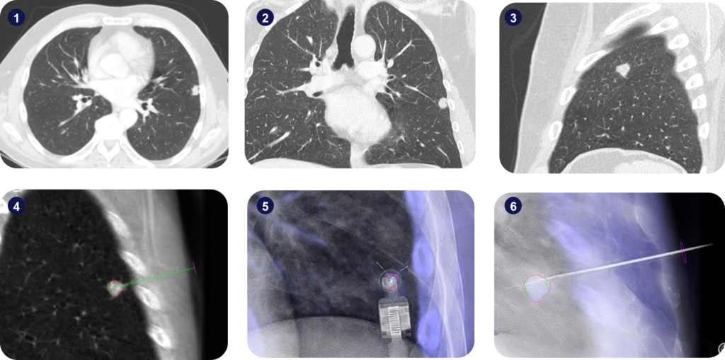 Imaging scans from robotic-assisted lung biopsoy