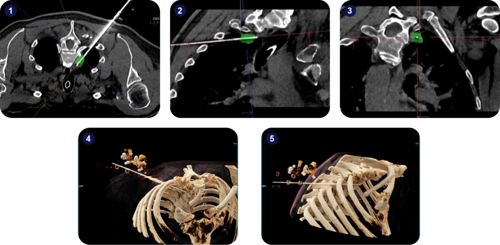 Biopsy needle insertion in the right lung apex paraventral during a CT-guided lung biopsy.