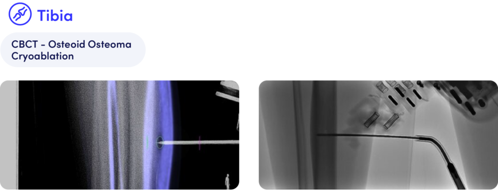Cryoablation performed in a patient with an osteoid osteoma in the right ventral tibia.