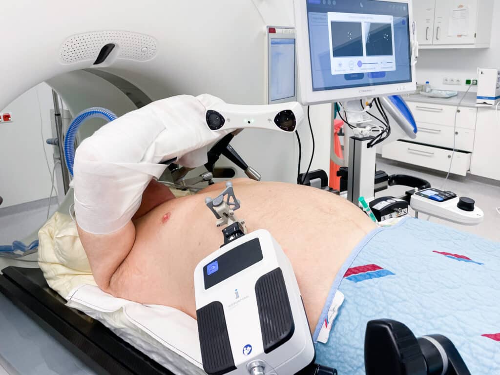 Micromate setup for CT guided liver ablation