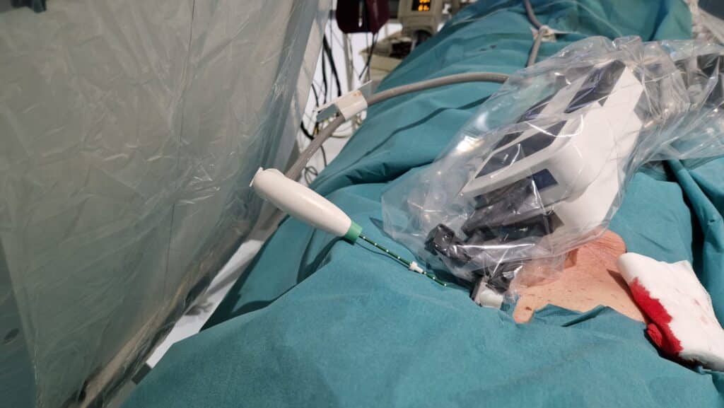Micromate in a steep angulation in a liver MW Ablation